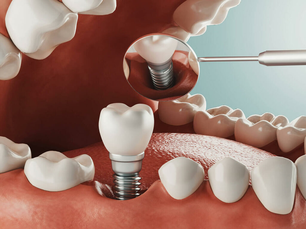 Graphic of a dental implant procedure
