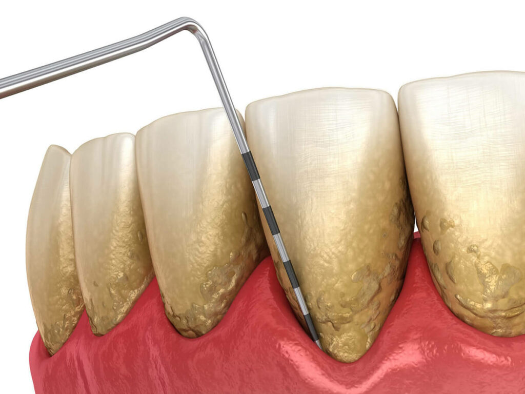 Periodontal disease being cleaned