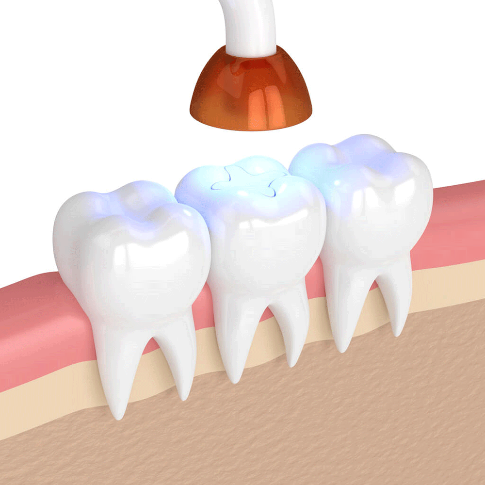 Dental sealant procedure