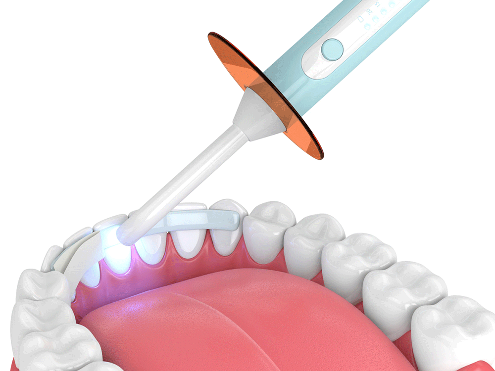 The image shows a dental procedure where a curing light is being used on a set of teeth. The blue light is hardening a dental adhesive or composite on an arch wire placed on the upper teeth.