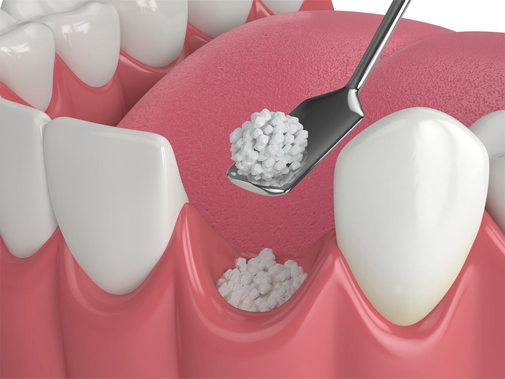 Graphic showing a dental bone grafting procedure