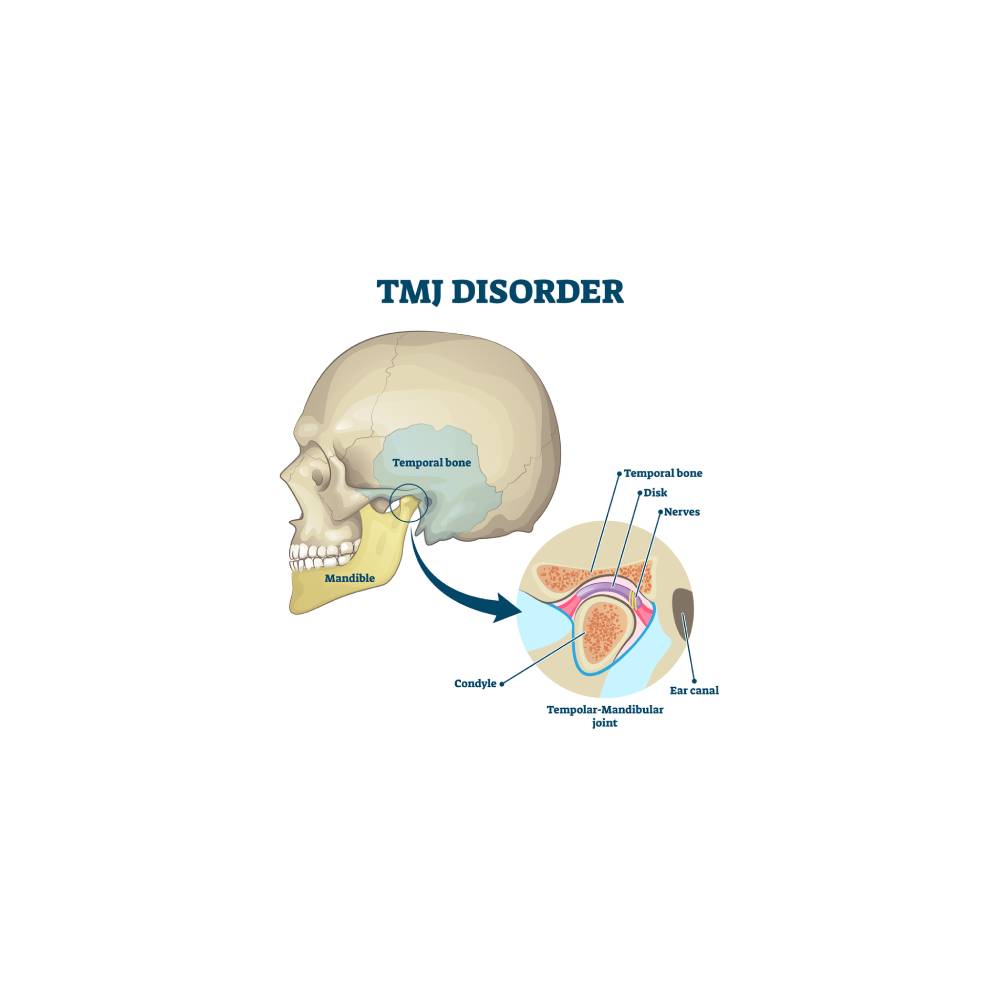TMJ disorder vector illustration. Labeled jaw condition educational scheme. Diagram with joint clicking and pain anatomical structure and explanation. TMJD syndrome with mandibular movement closeup.